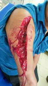 Funcionário do banco sofreu um corte profundo no momento do assalto para que soltasse o malote com dinheiro